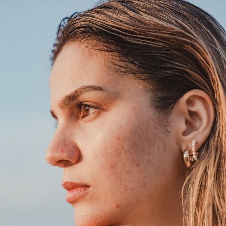 صورة للفئة الندبات