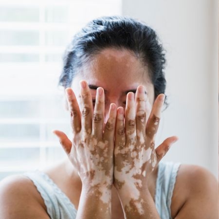 صورة للفئة البهاق 