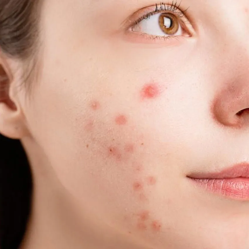 How do I remove acne?